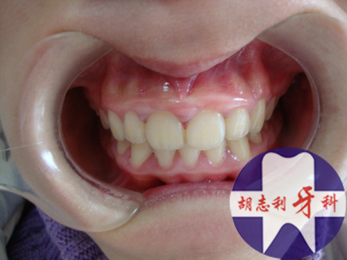 牙齿矫正案例3(门牙内倾)