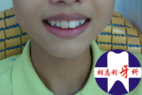 有点龅牙怎么办_有点小龅牙怎么办_牙齿有点